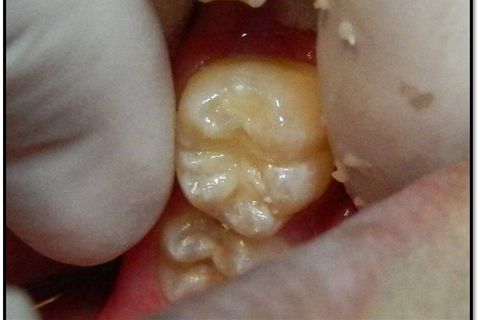 Usando um instrumental de sua escolha remova os excessos e fotopolimerize