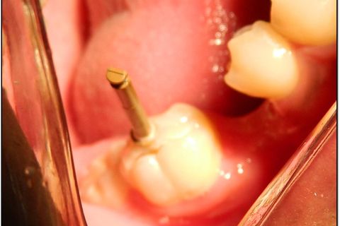 Utilizando uma peça para usar como haste para facilitar inserção (broca, fio de orto, no caso uma haste de enhance) use uma quantidade de resina composta (essas mais em conta como liss, filmagic) que cubra toda a face oclusal e cubra a haste...