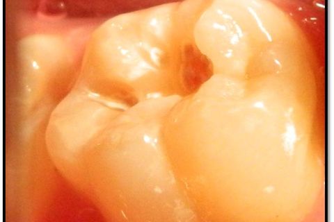 Faça os procedimentos tradicionais de remoção de tecido cariado e preparo para resina composta.