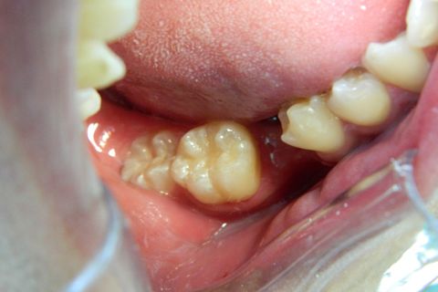 Classe I Perfeitas, Sem Ajustes Oclusais em Minutos