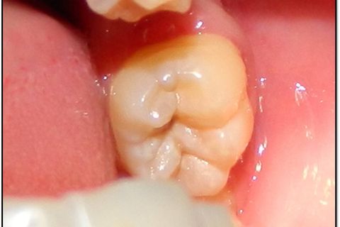 Observa-se face oclusal preservada, excelente para o uso da técnica que desenvolvi.