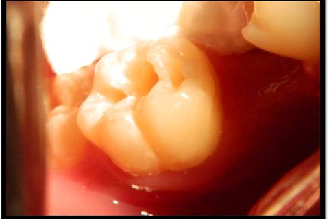 Classe I Perfeitas, Sem Ajustes Oclusais em Minutos