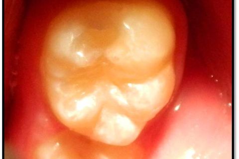 Classe I Perfeitas, Sem Ajustes Oclusais em Minutos