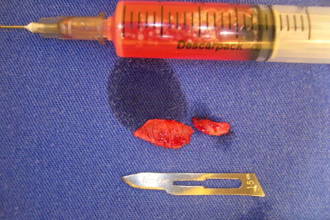 Conteúdo cístico e espécime para análise histológica.