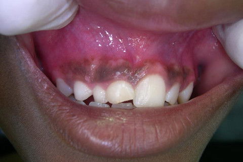 Visão do rebordo alveolar