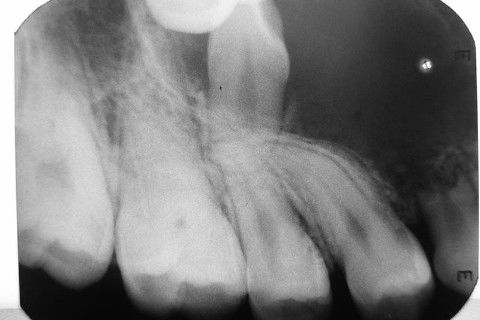 Rx periapical