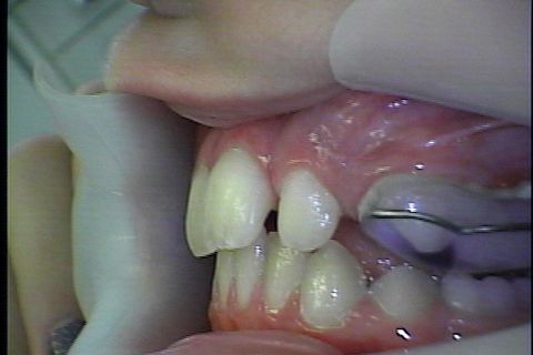 Disjunção realizada