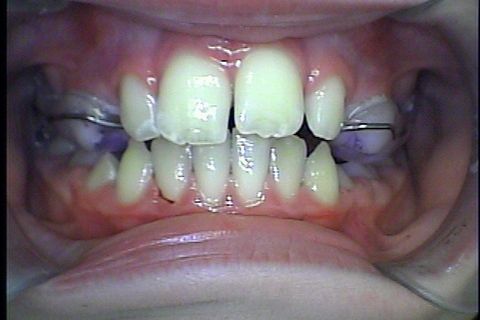 Instalaçao do disjuntor para criar espaço