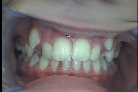 Antes da colocaçao de aparelho fixo