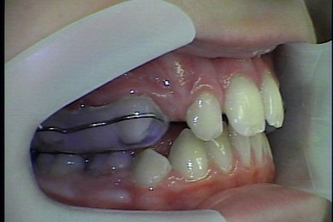 Disjunção realizada