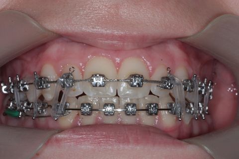 Fase Final, intercuspidando e talvez haverá necessidade de desgastes interproximais devido a Bolton superior