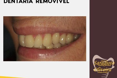 Proteses Dentárias