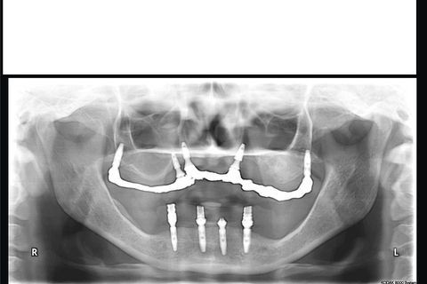 Panorâmica 8 meses pós op. Há uma pequena desadaptação da barra aos mini pilares devido a afrouxamento de dois parafusos que foi corrigido e apertados(havia um pequeno incremento metálico em um dos pilares - defeito de fundição)