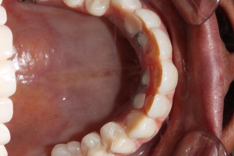 oclusal - extensão da barra polida para captura dos implantes pterigóides.