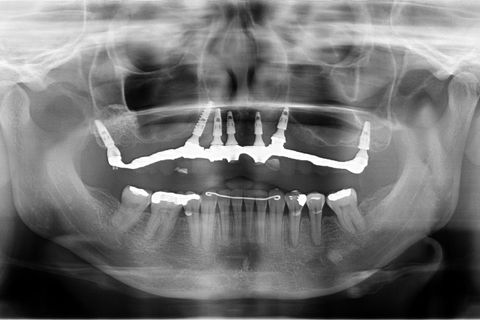 Controle Radiográfico 2015, após tratamento ortodôntico e nova prótese instalada. Nível ósseo mantido de forma bastante saudável. Implantes cone morse.