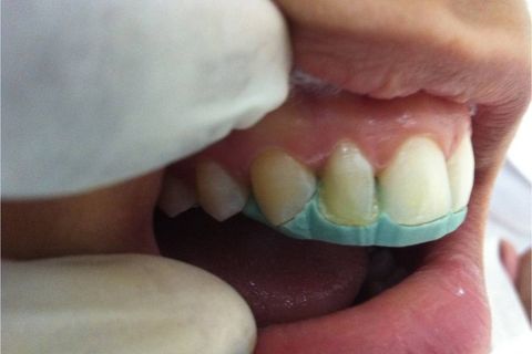 Reconstrução da face palatina com Resina EA2