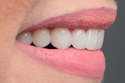 Lentes de Contato Dentais