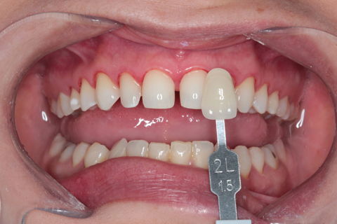 Tomada de cor - Substrato