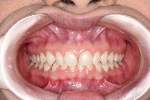 Lentes de Contato Dentais