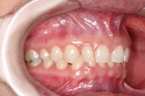 Lentes de Contato Dentais