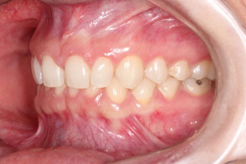 Lentes de Contato Dentais