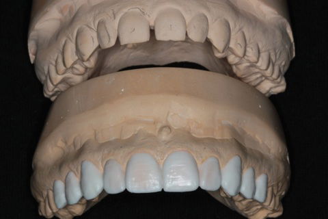 Enceramento Diagnóstico referenciado pelo DSD