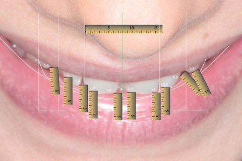 Digital Smile Design - DSD