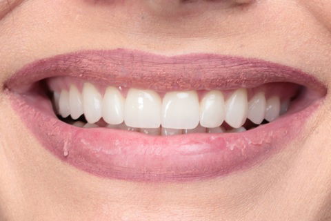 Lentes de Contato Dentais