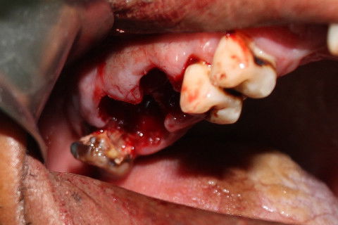 Visão dos alvéolos vasios e do dente 18 indicado para extração, visto que apresentava processo carioso e não possuia um antagonista para ocluir.