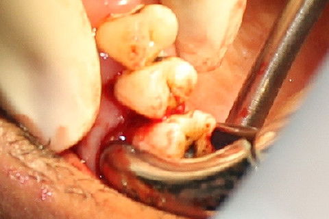 Luxação e avulsão do elemento 16. Fóceps 18R