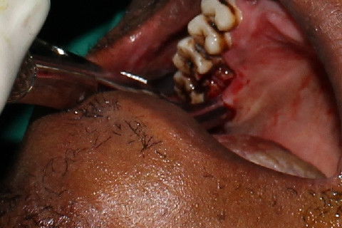 Luxação e avulsão do elemento 17. Fóceps 18R