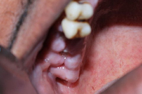 Após remoção de sutura. 7 dias