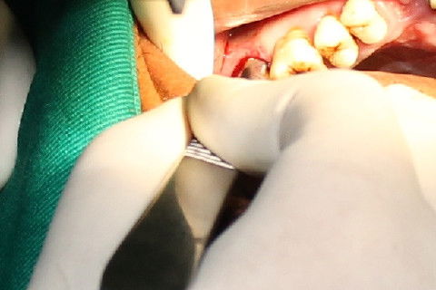 Após as devidas anestesia, incisão intrasulcular.