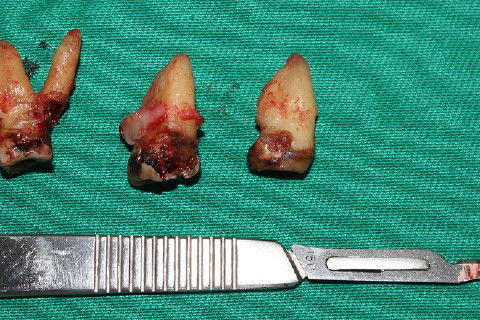 dentes 16, 17 e 18 extraidos.