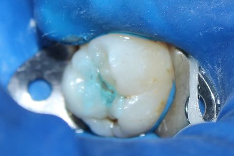 condicionamento ácido - ácido fosfórico a 37%