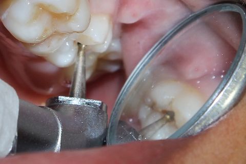 Uso da broca esférica carbide em baixa rotação para remoção de dentina cariada