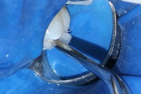 profilaxia da cavidade com clorexidina a 0,2%