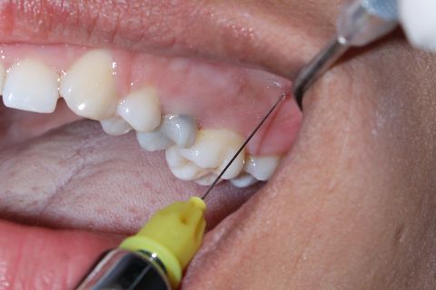 Anestesia infiltrativa