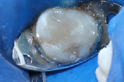 Incrementos de Resina Composta Esmalte cor A2 Z350