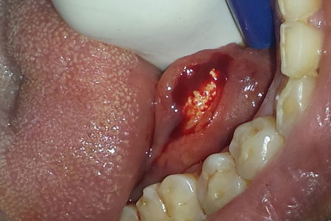 Incisão do ducto da glândula e exposição do Sialolíto