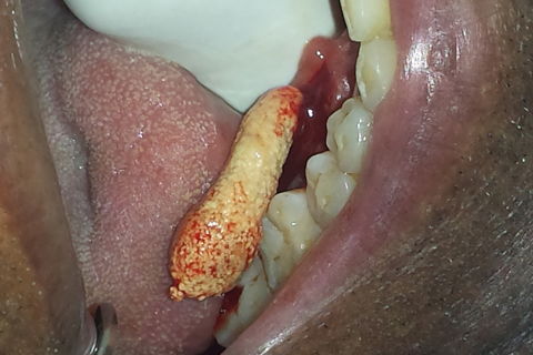 Remoção do sialolíto