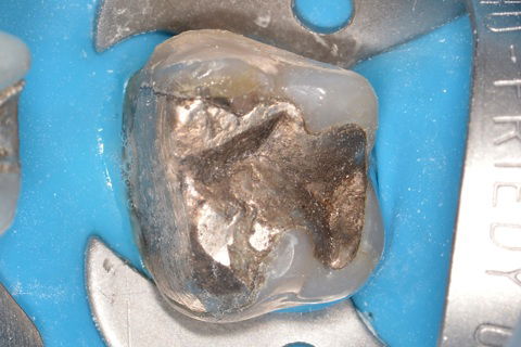 Restauração de amálgama