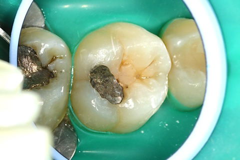 Restauração fracassada