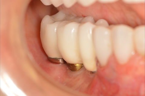 Prótese final adequada e permitindo boa higienização