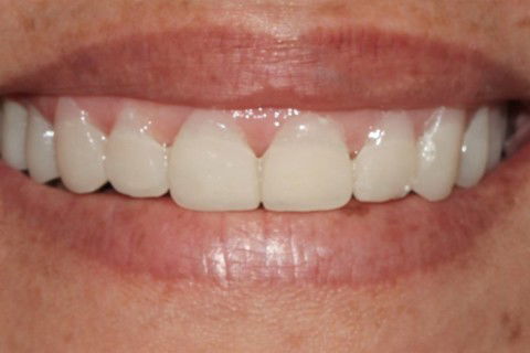 Confecção de guia cirúrgico para a correção dos zênites e contornos gengivais