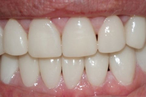 Reabilitação da Dvo: Sorriso Gengival e Diastemas com Facetas e Overlays em Resina Indireta