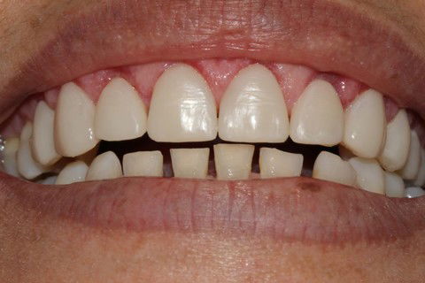 Cicatrização da gengivectomia e prova de cor e forma das facetas e overlays superiores