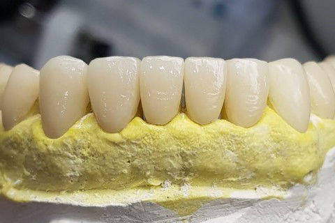 Reabilitação da Dvo: Sorriso Gengival e Diastemas com Facetas e Overlays em Resina Indireta