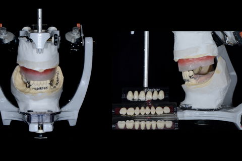 Montagem de dentes - Dentes Classic (Kulzer - Alemanha).