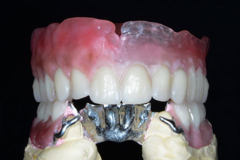 Remoção da escultura vestibular das próteses hemi-arco.